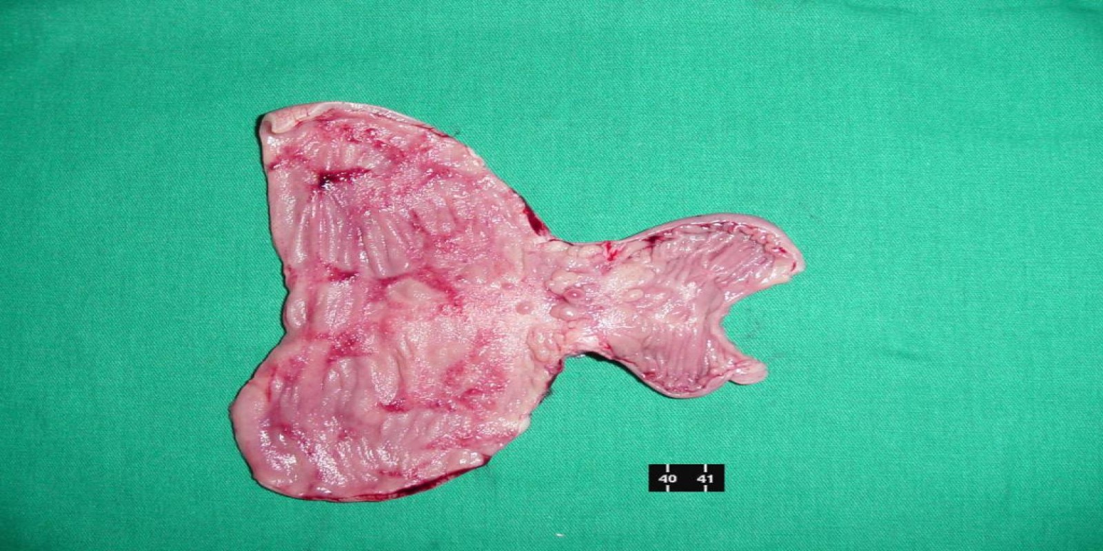 Caso Código 070C de Doença de Crohn 070C