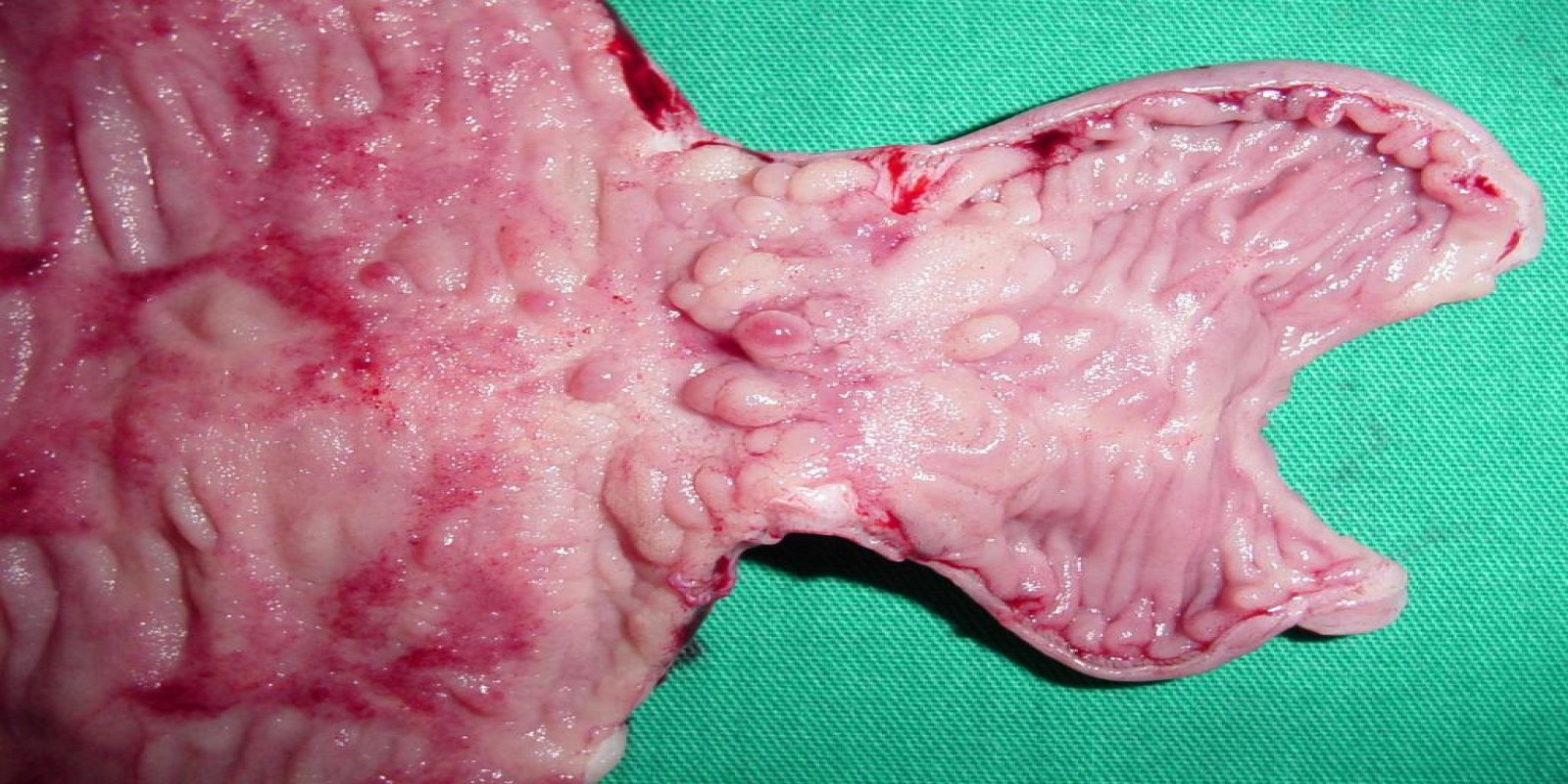 Caso Código 070D de Doença de Crohn 070D