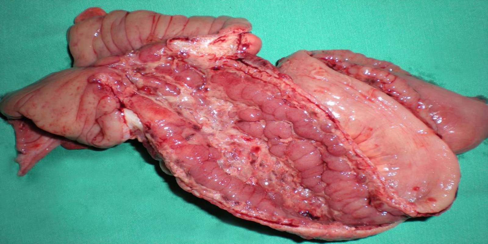 Caso Código 071C de Doença de Crohn 071C