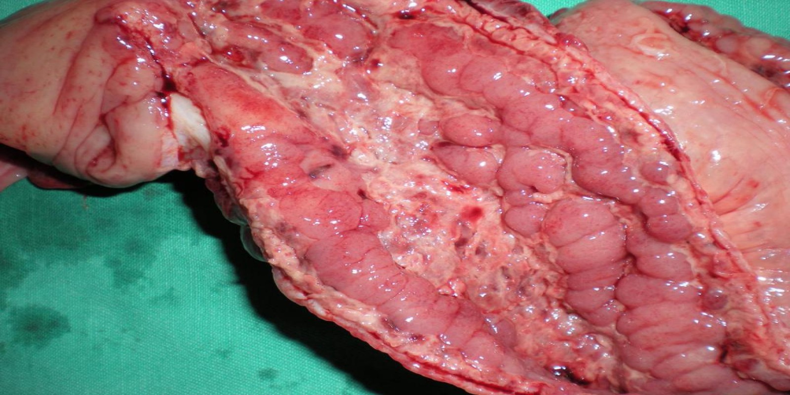 Caso Código 071D de Doença de Crohn 071D