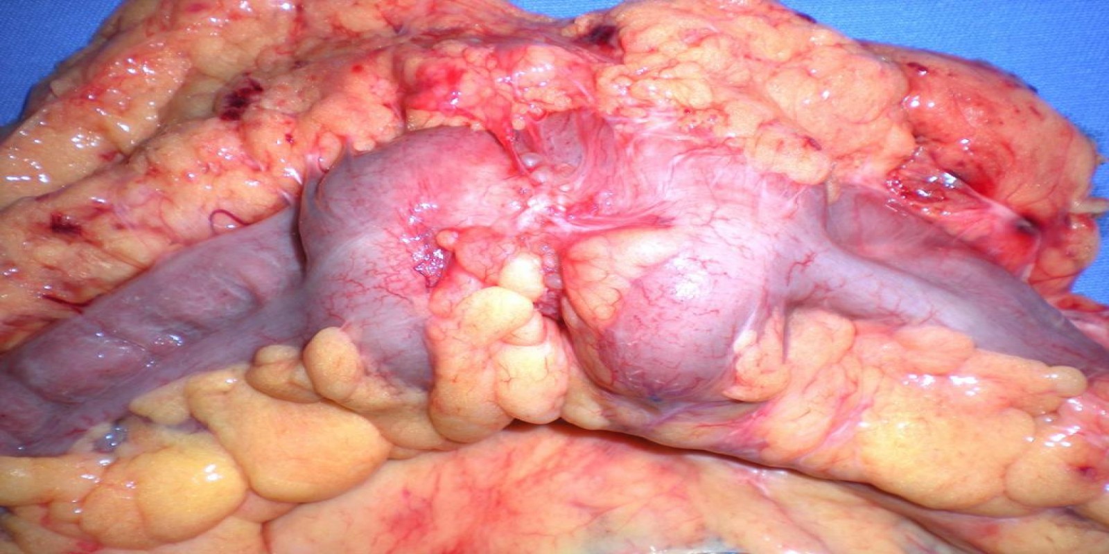 Caso Código 073A de Câncer do Cólon 073A