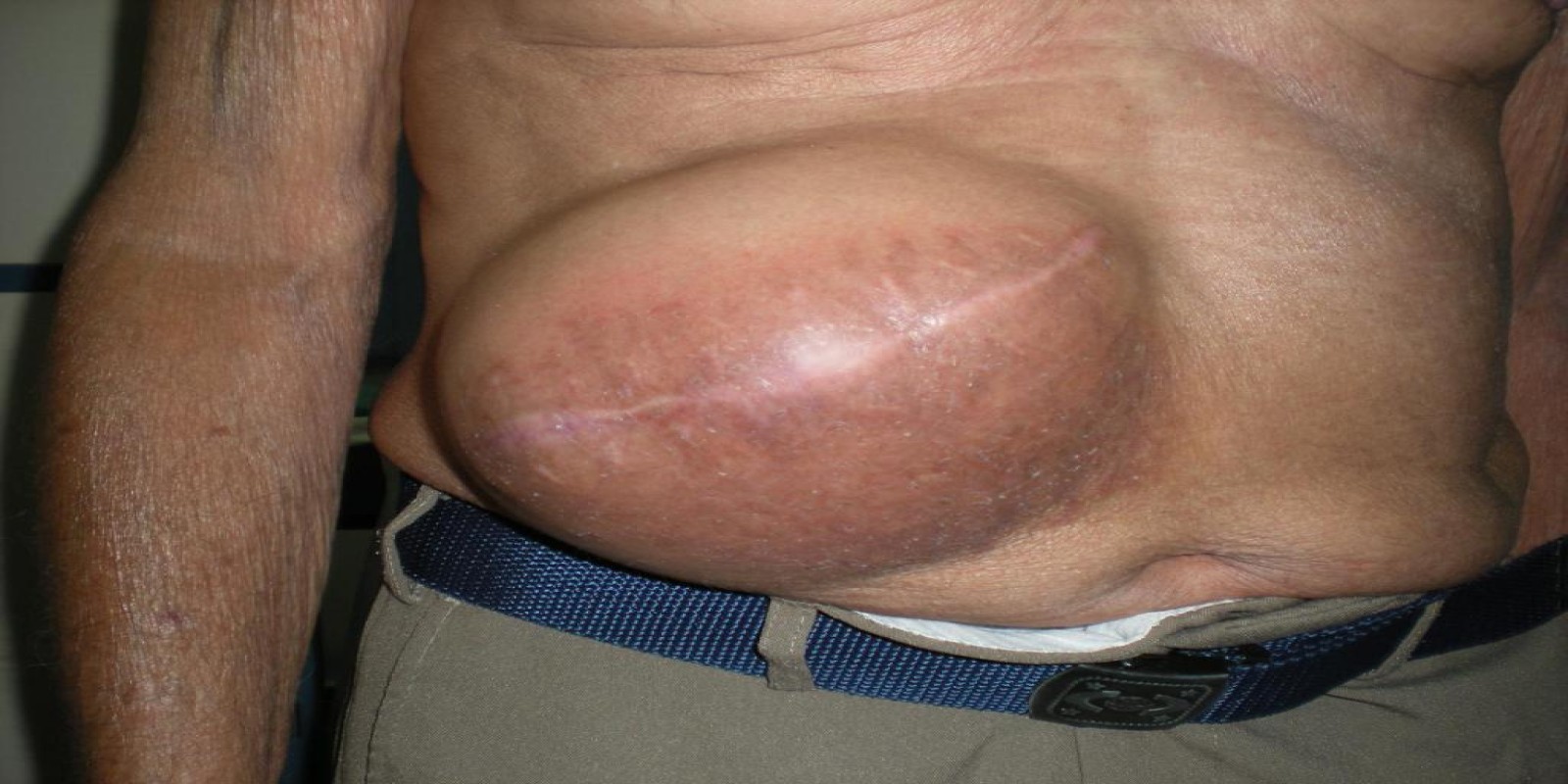 Caso Código 074A de Hérnia Incisional 074A