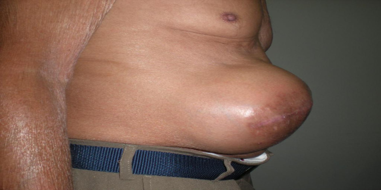 Caso Código 074B de Hérnia Incisional 074B