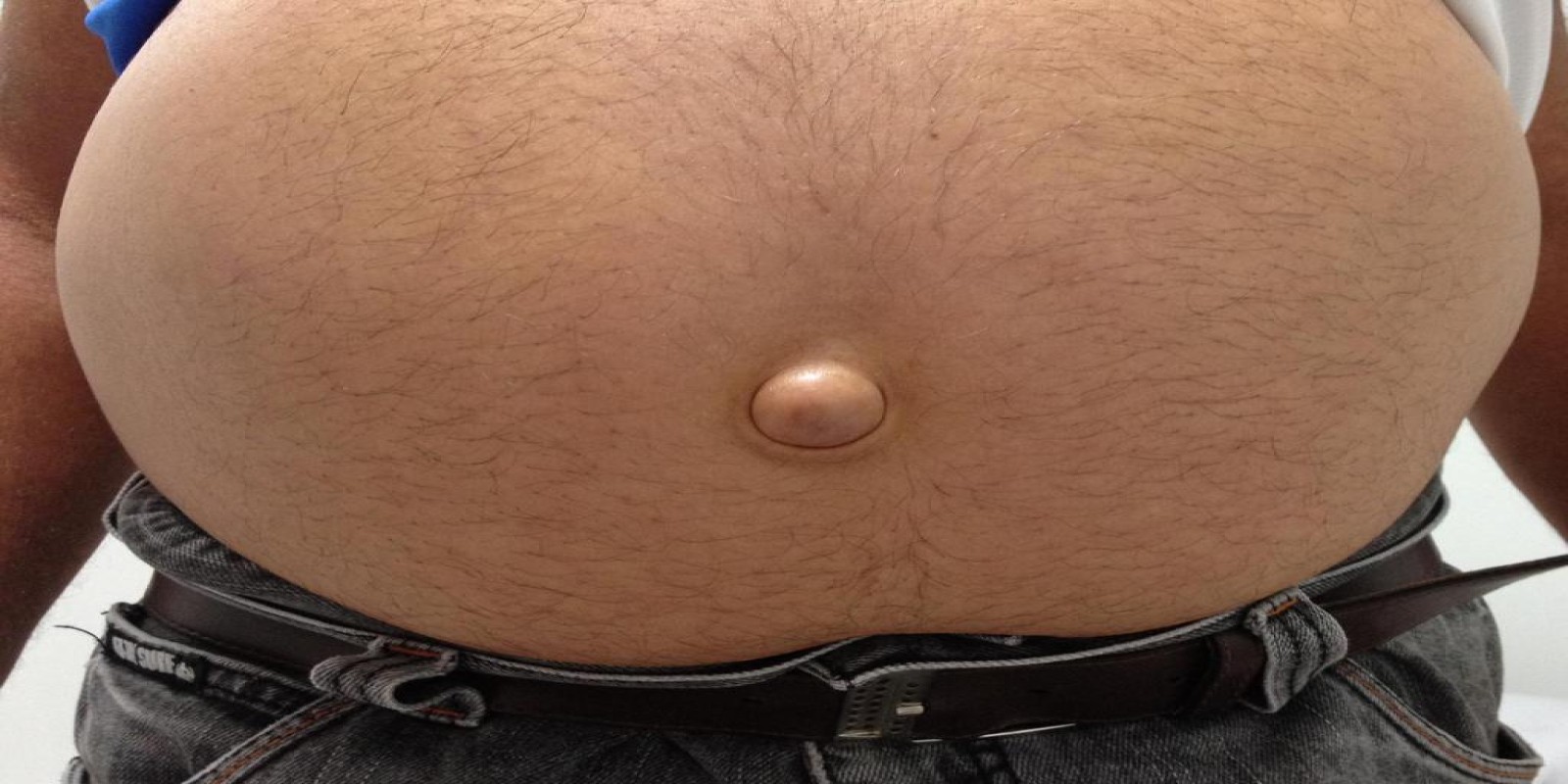 Caso Código 076A de Hérnia Umbilical 076A