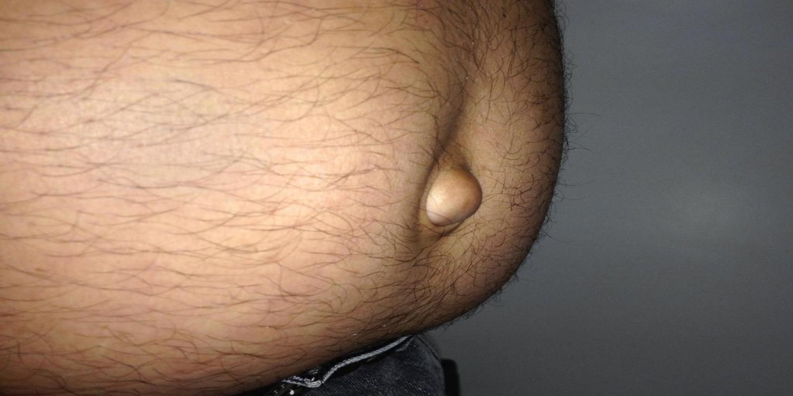 Caso Código 076B de Hérnia Umbilical 076B