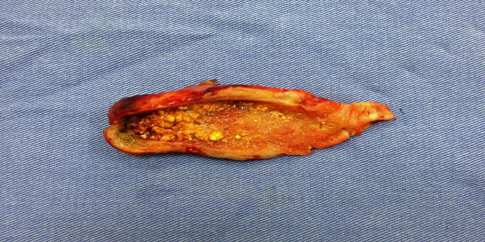 Caso Código 077A de Colecistite Aguda 077A