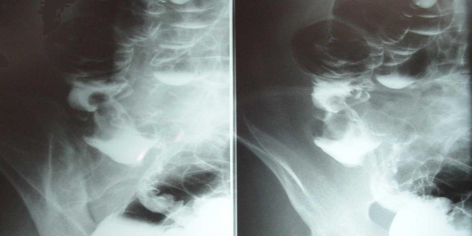 Caso Código 012A de Câncer do Cólon 012A