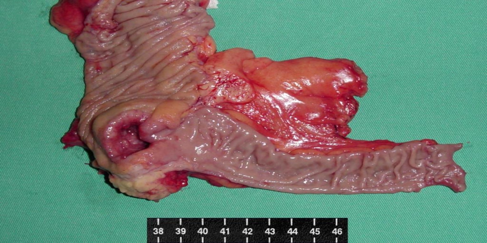 Caso Código 012B de Câncer do Cólon 012B