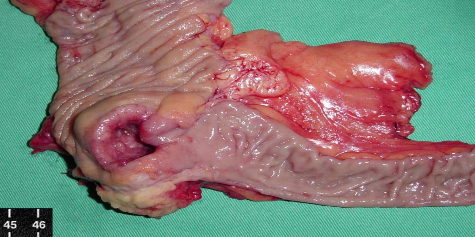 Caso Código 012C de Câncer do Cólon 012C