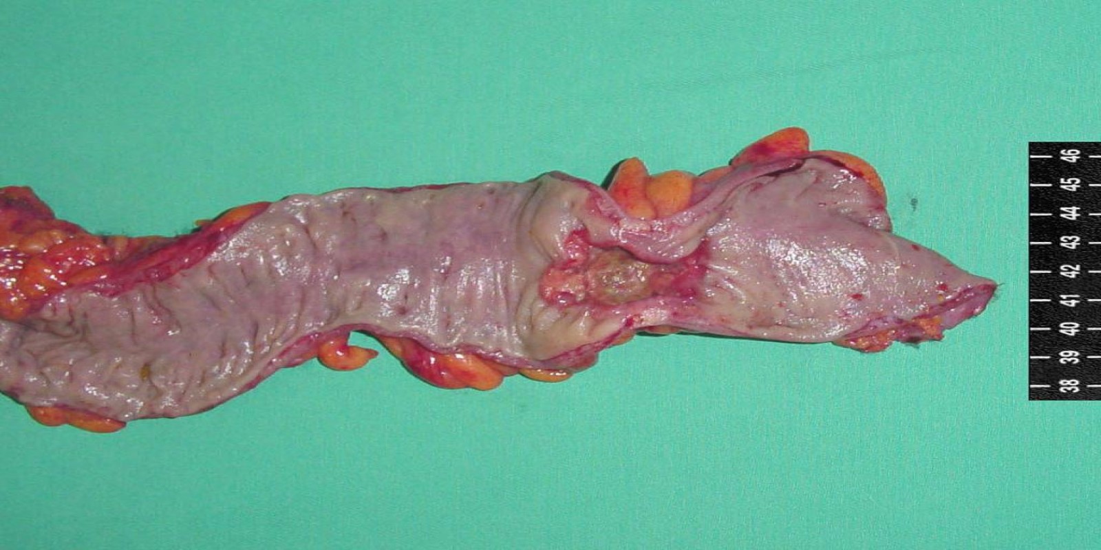 Caso Código 015A de Câncer do Cólon 015A