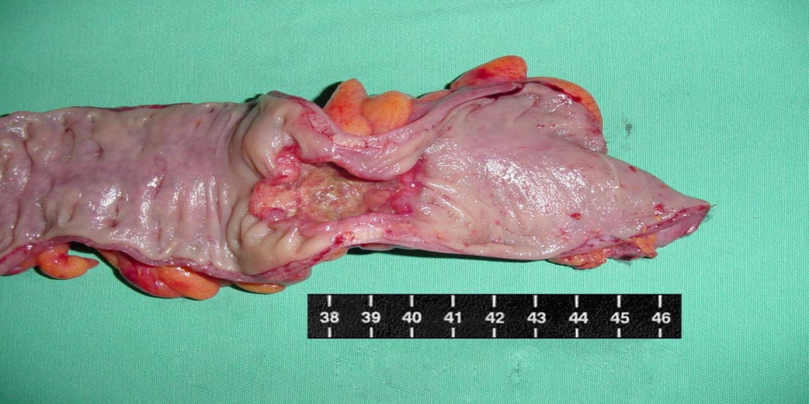Caso Código 015B de Câncer do Cólon 015B