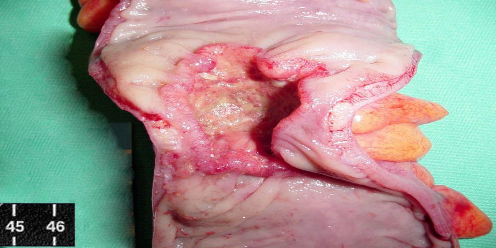 Caso Código 015C de Câncer do Cólon 015C