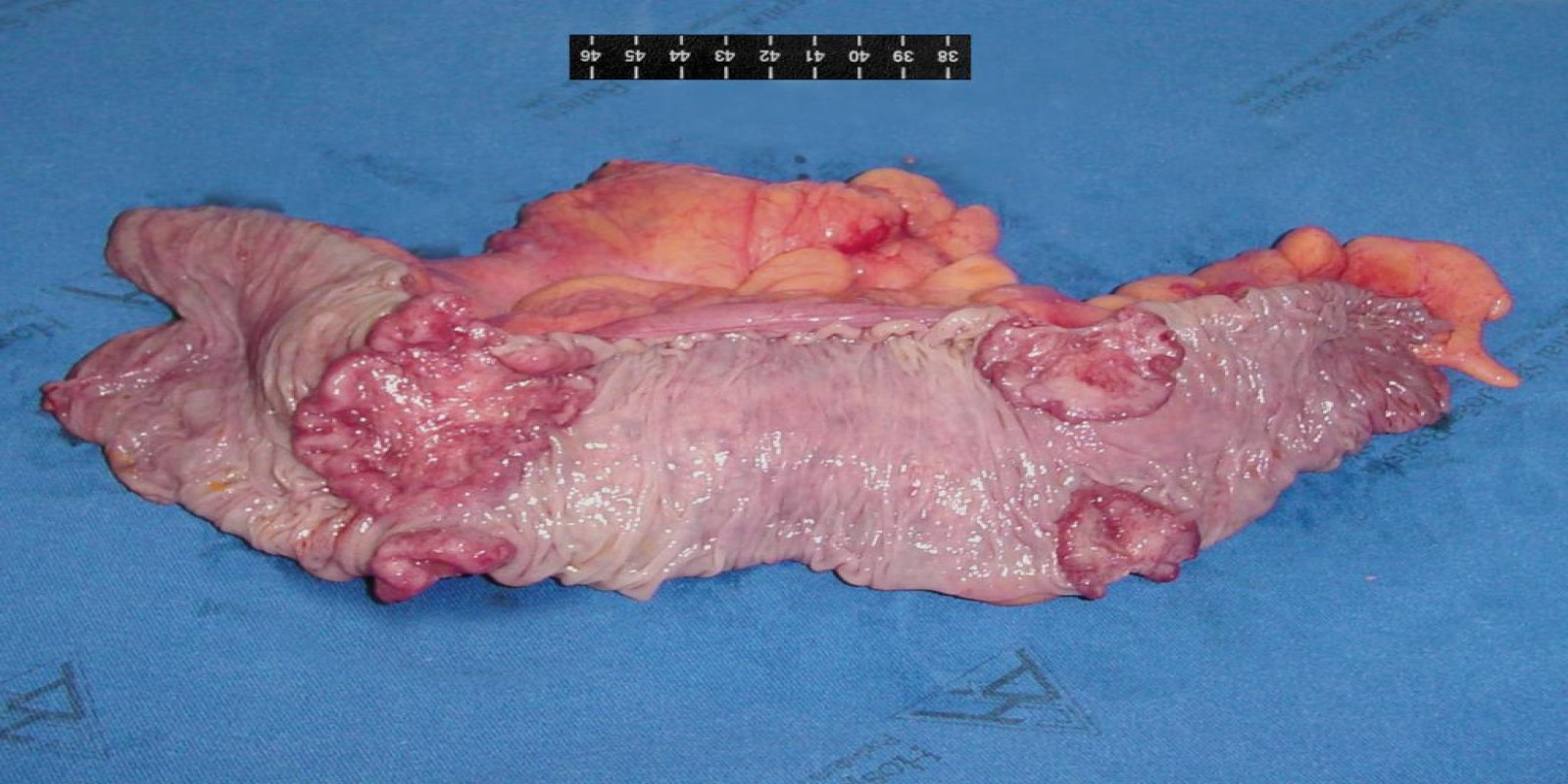 Caso Código 016A de Câncer do Cólon 016A