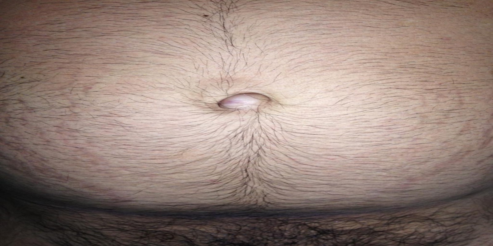 Caso Código 087A de Hérnia Umbilical 087A