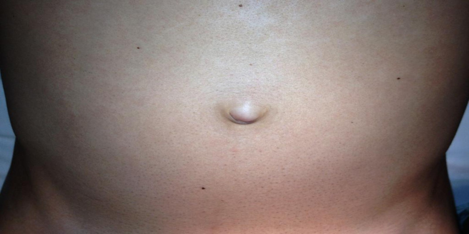 Caso Código 088A de Hérnia Umbilical 088A