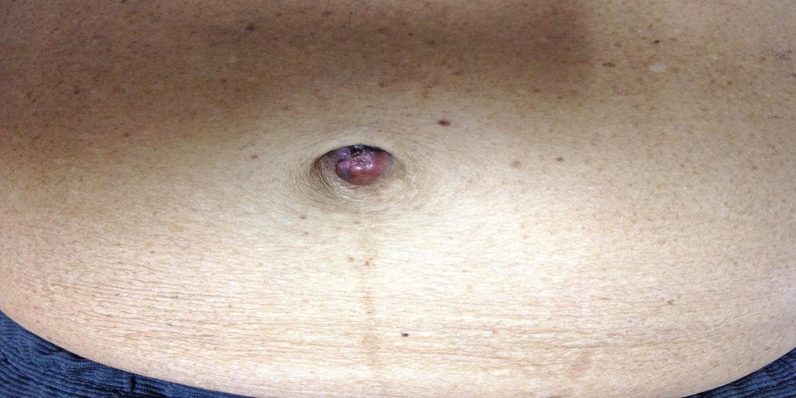 Caso Código 089A de Câncer Gástrico 089A