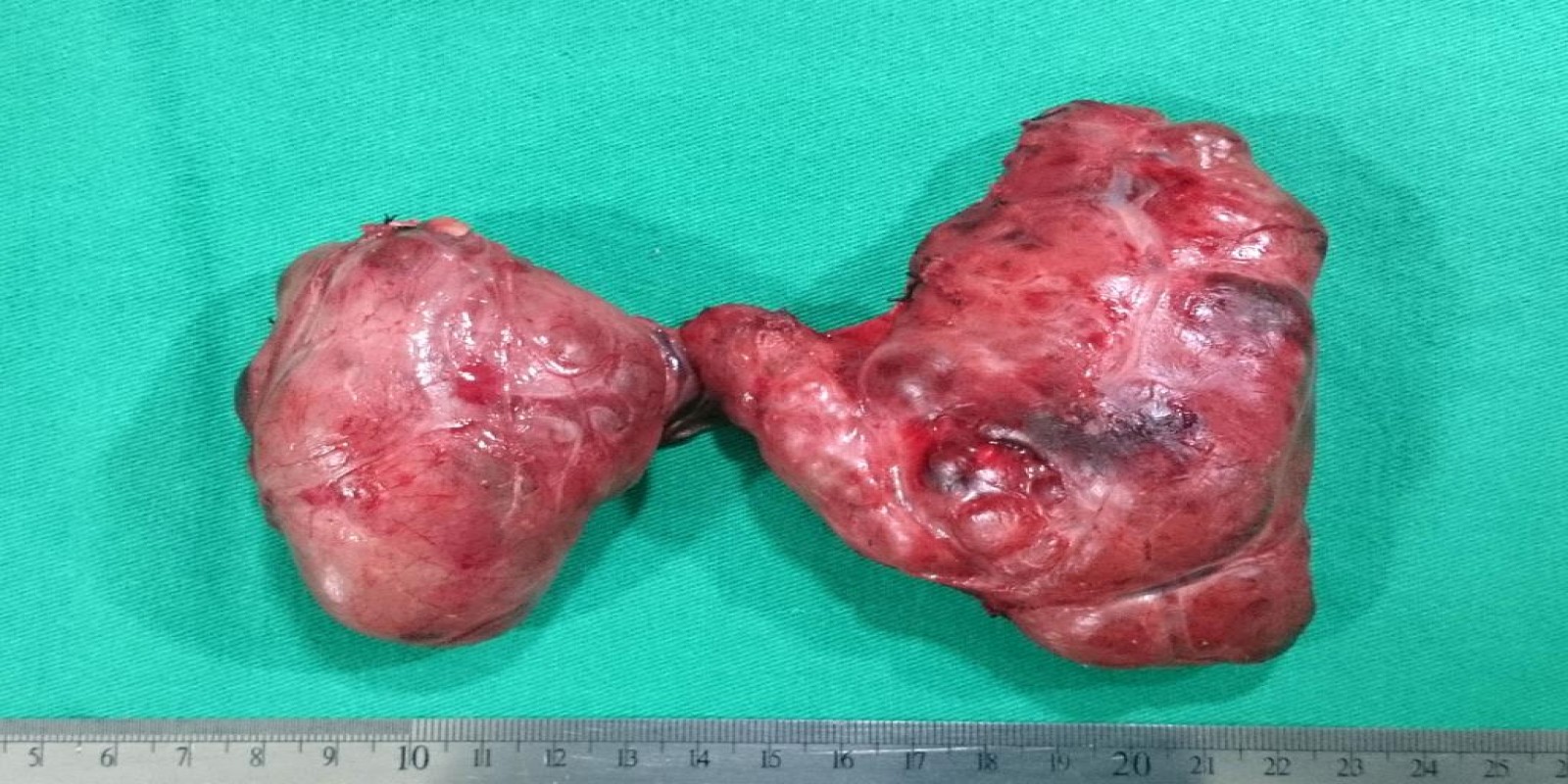 Caso Código 098A de Bócio Multinodular Atóxico 098A