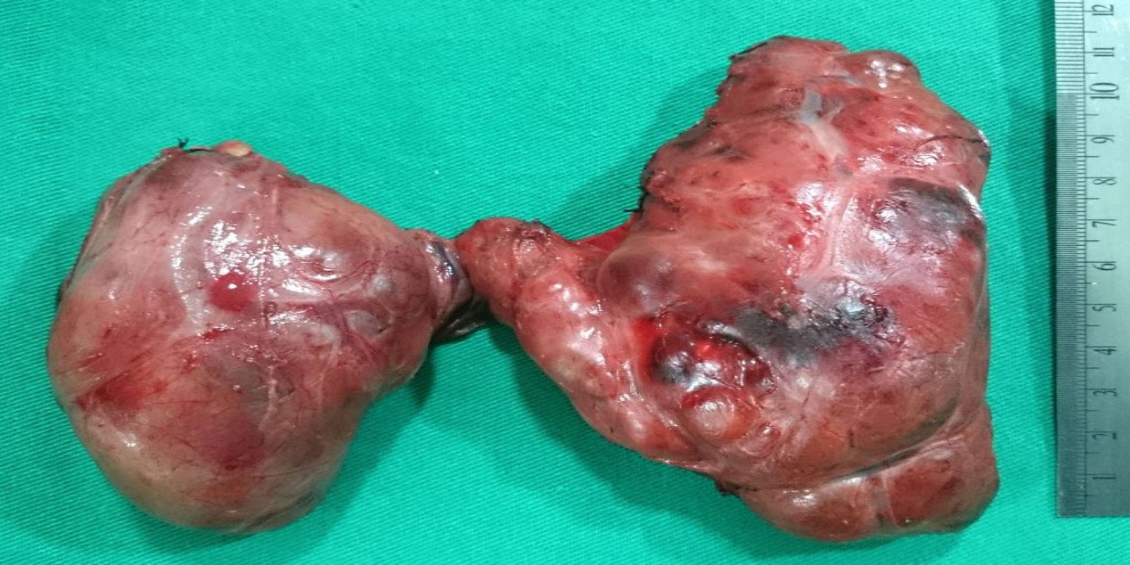 Caso Código 098B de Bócio Multinodular Atóxico 098B