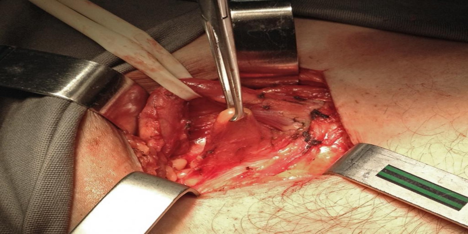 Caso Código 103B de Hérnia Inguinal 103B