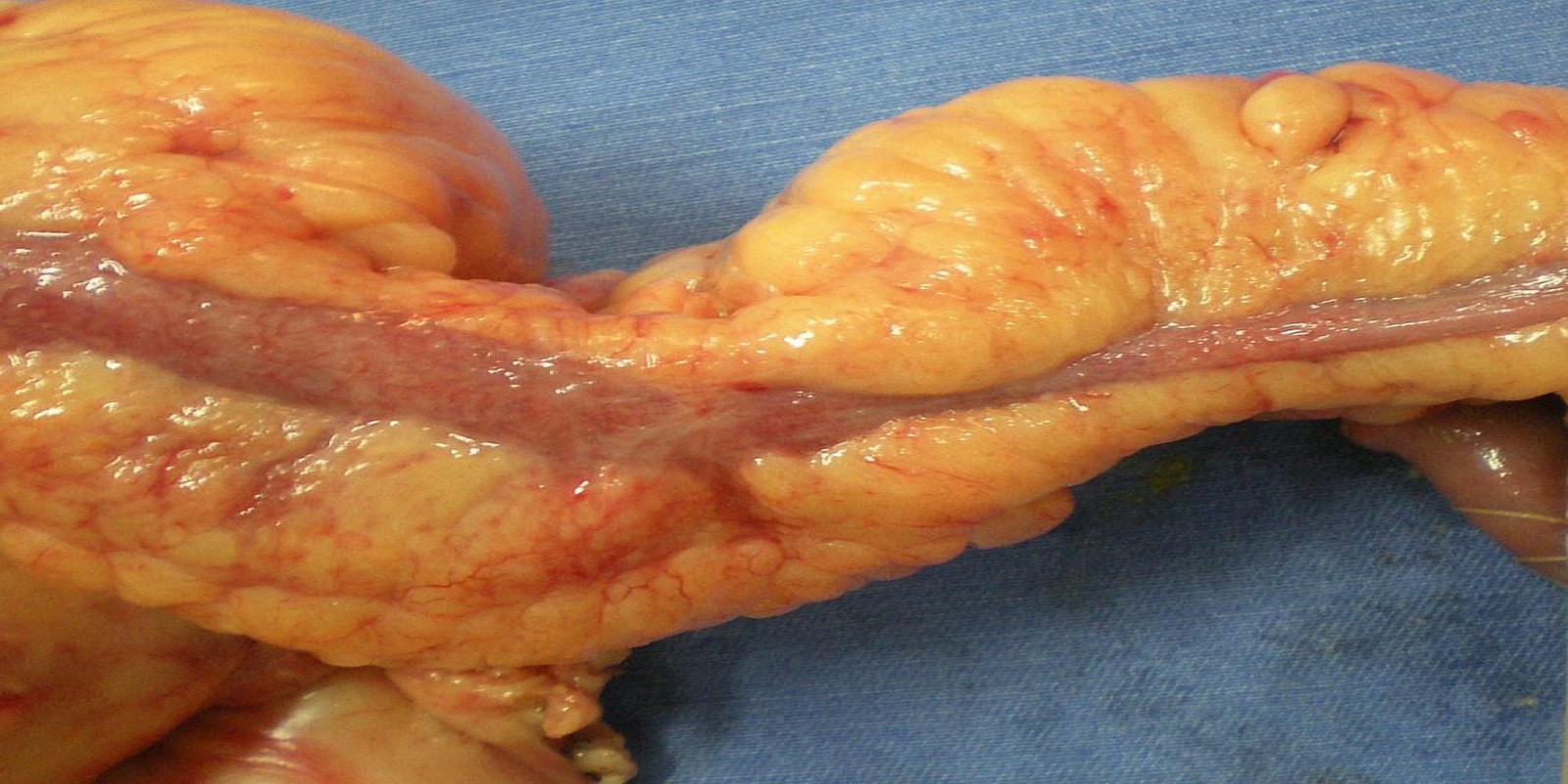 Caso Código 104A de Doença de Crohn 104A