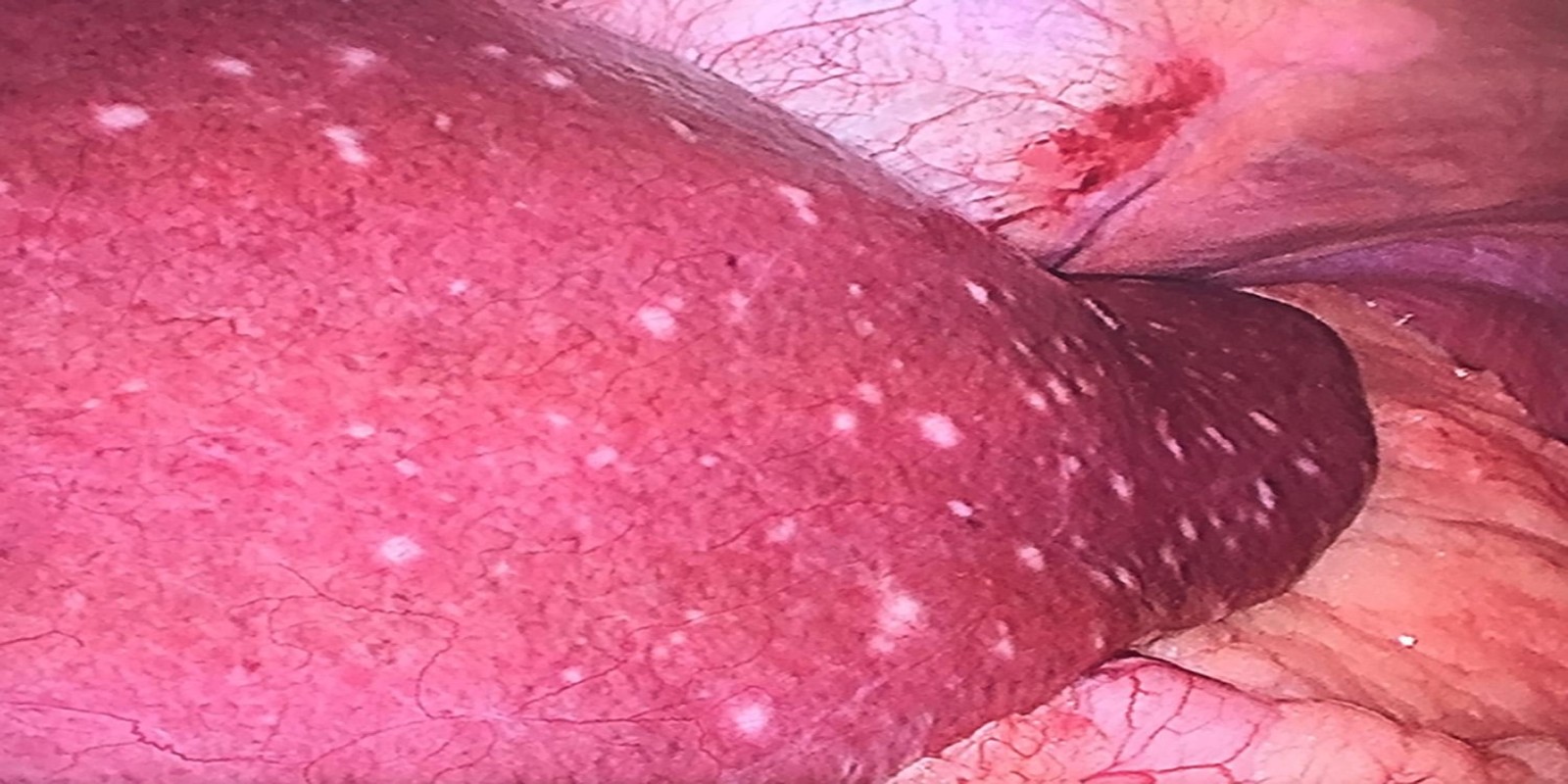 Caso Código 124A de Abscesso Hepático 124A