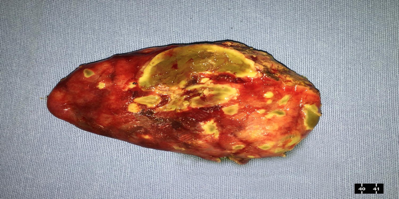 Caso Código 125A de Colecistite Aguda 125A