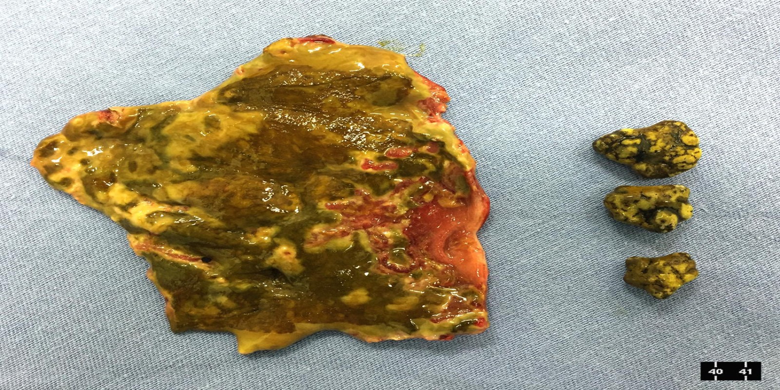 Caso Código 125B de Colecistite Aguda 125B