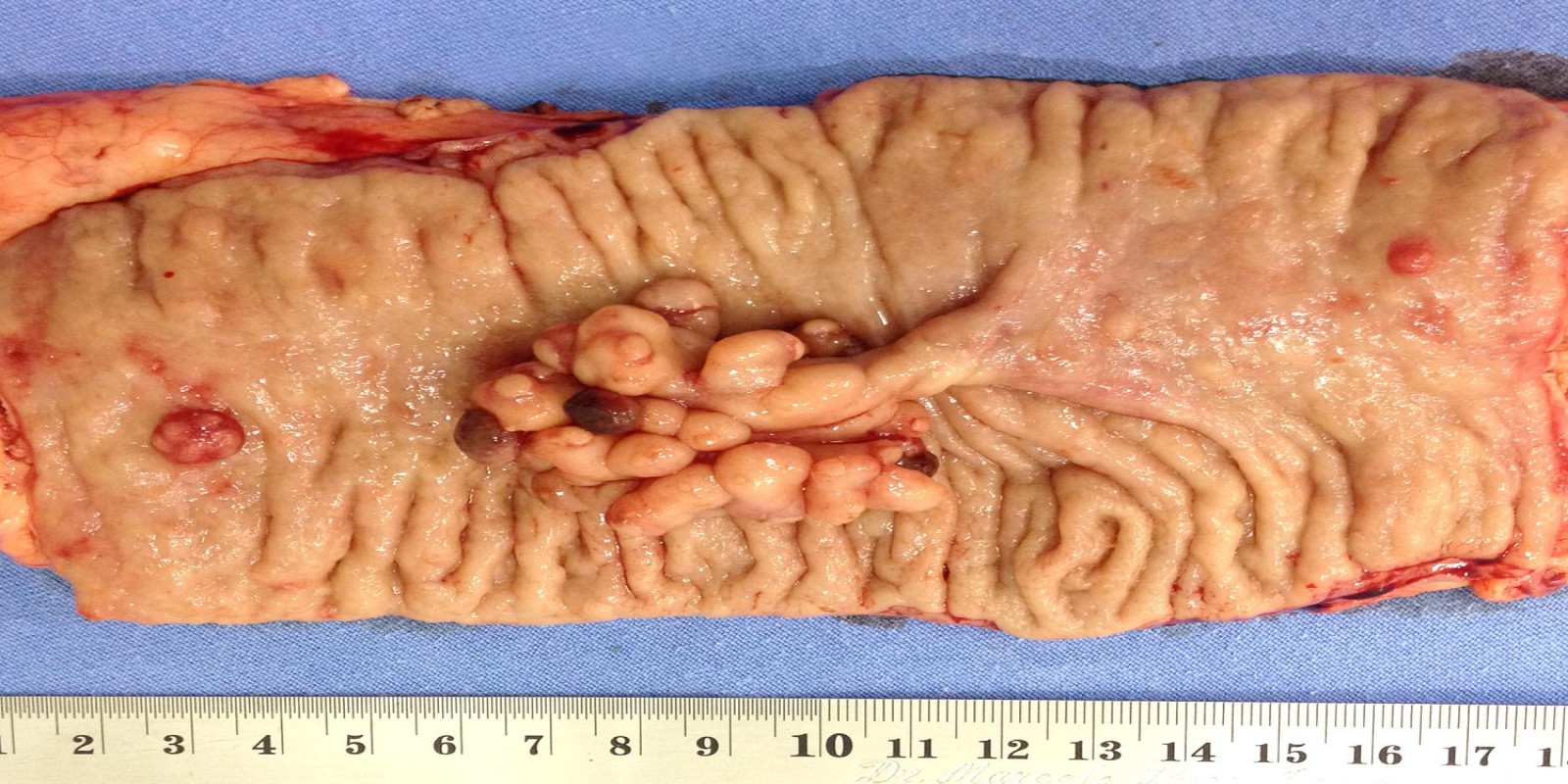 Caso Código 126A de Pólipos do Cólon 126A