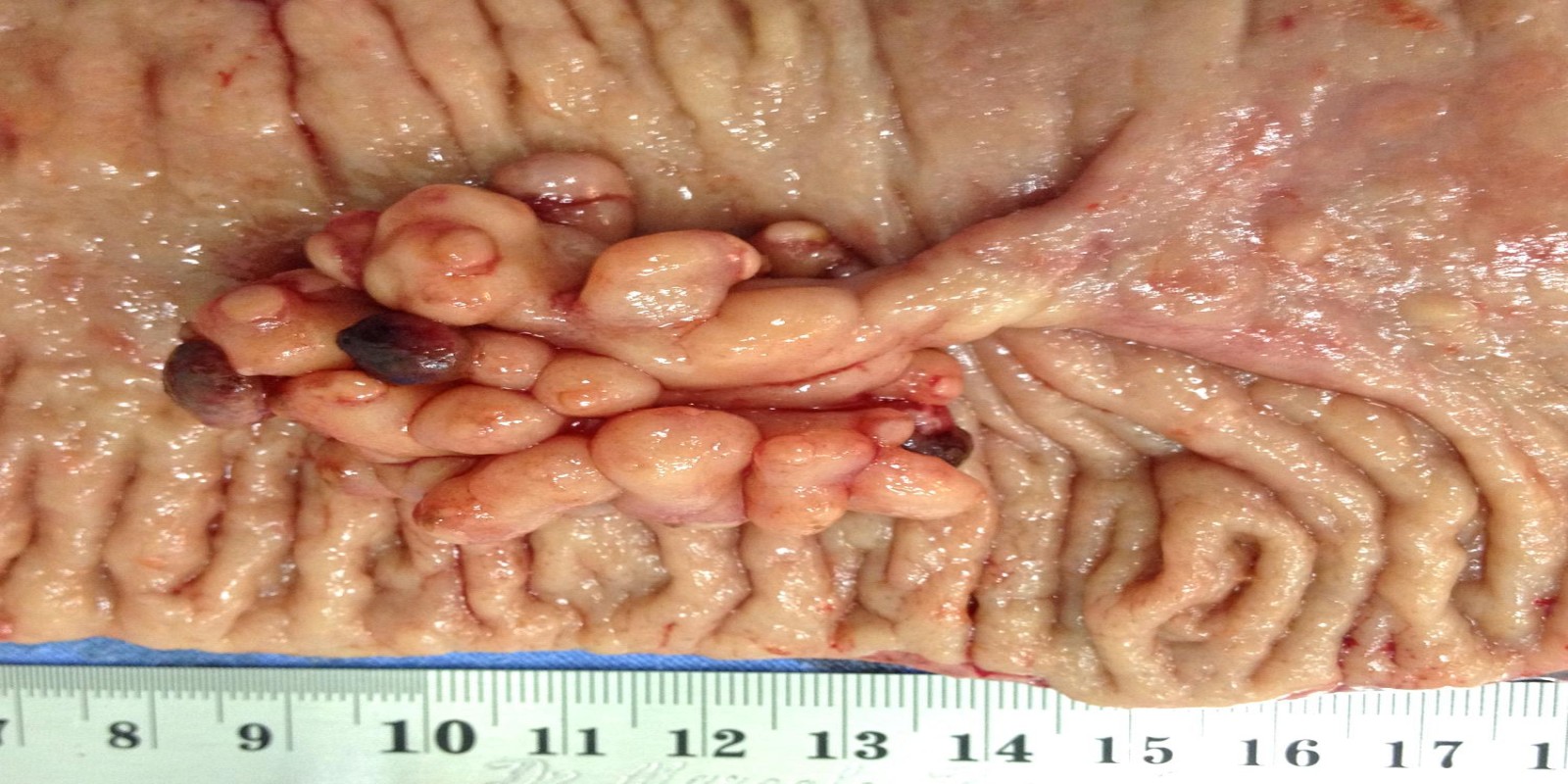 Caso Código 126B de Pólipos do Cólon 126B