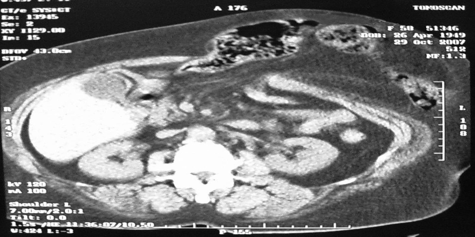 Caso Código 127A de Hérnia Incisional 127A