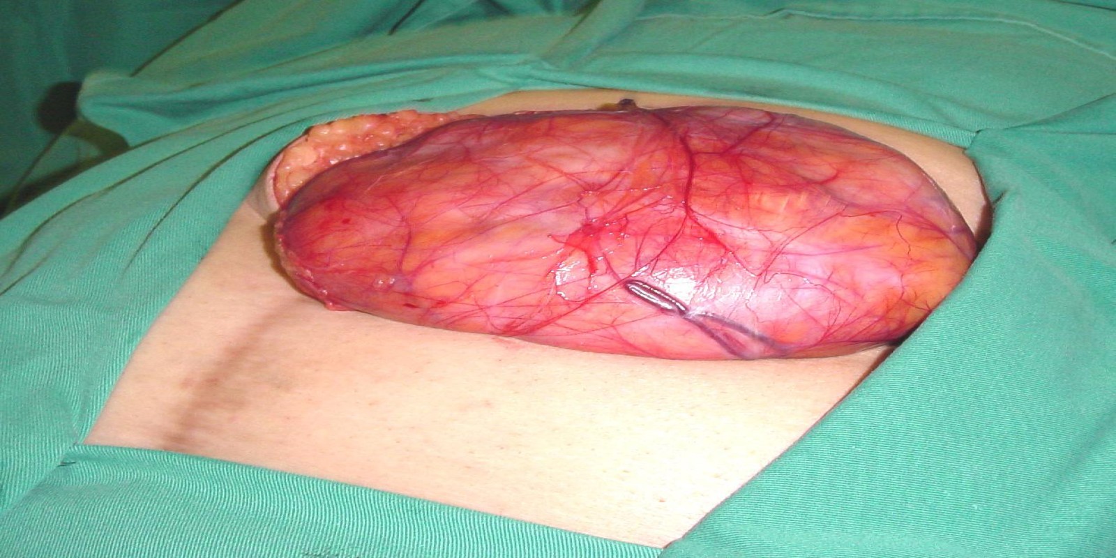 Caso Código 127B de Hérnia Incisional 127B