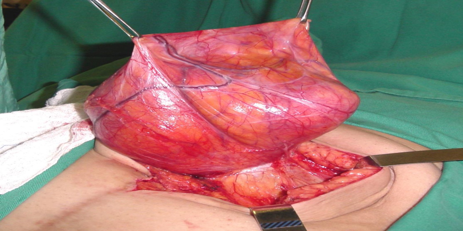 Caso Código 127C de Hérnia Incisional 127C