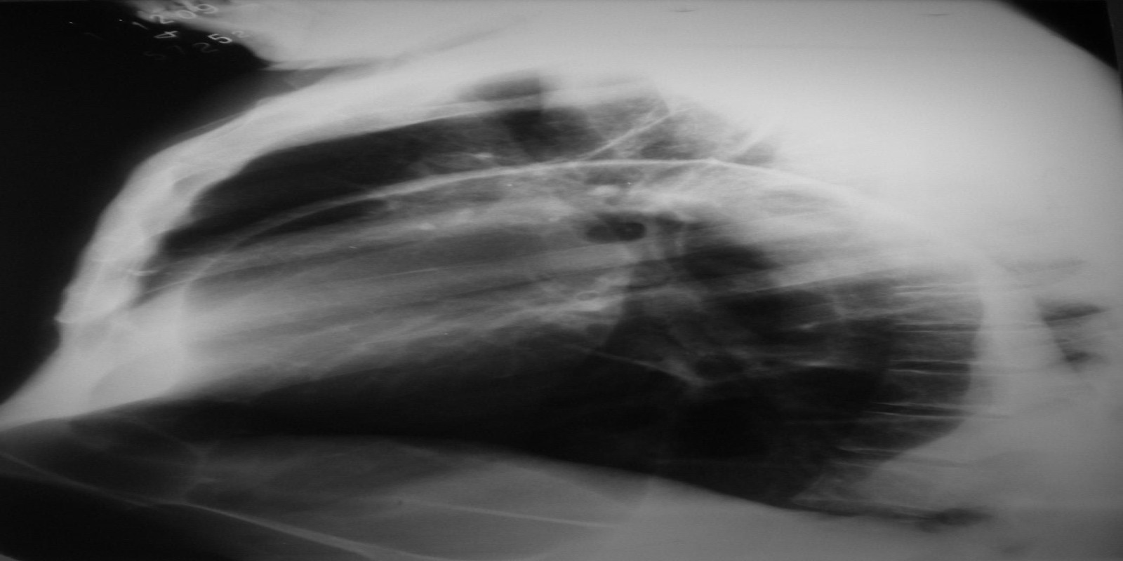 Caso Código 129A de Eventração diafragmática 129A