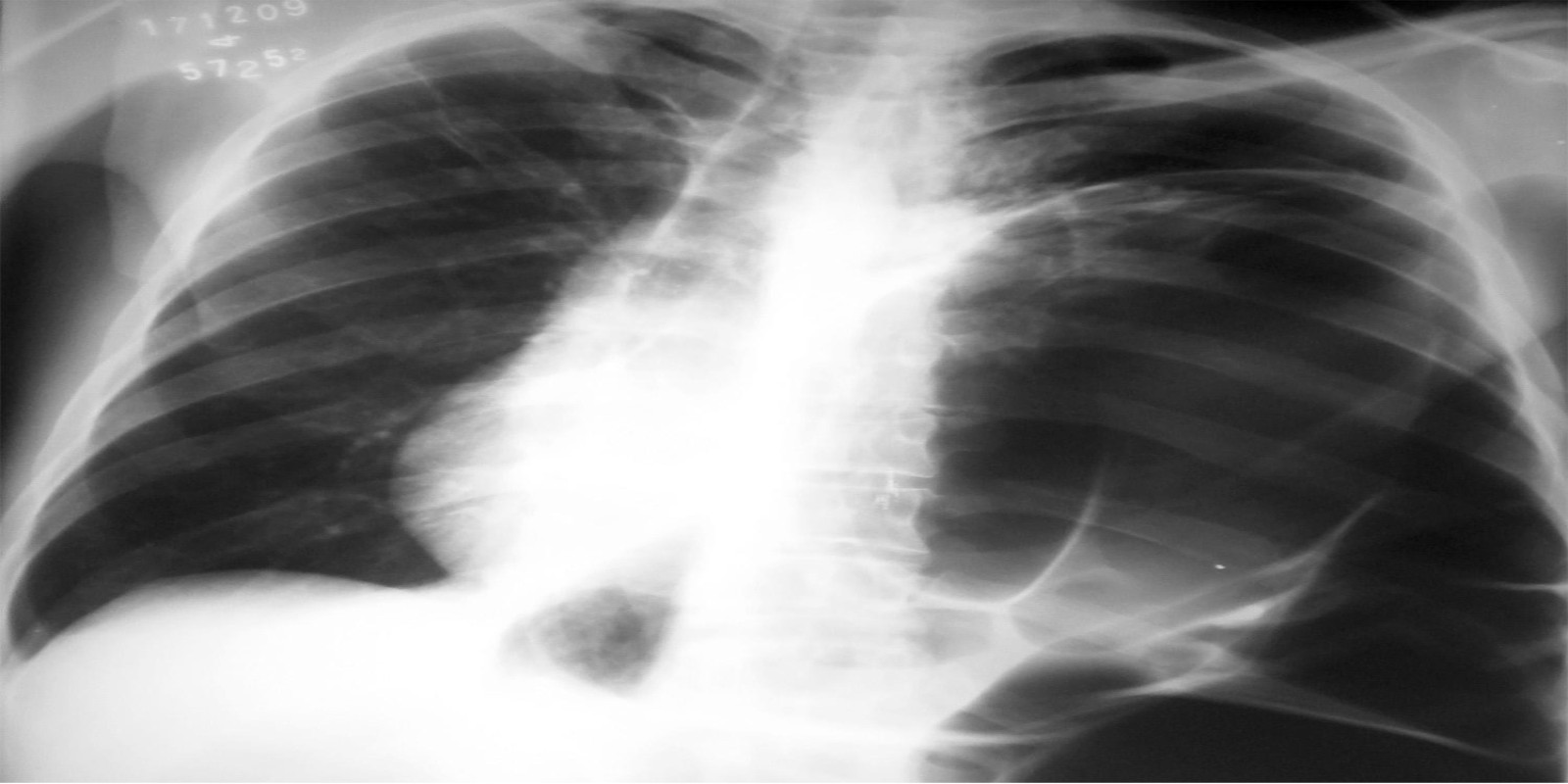 Caso Código 129B de Eventração diafragmática 129B