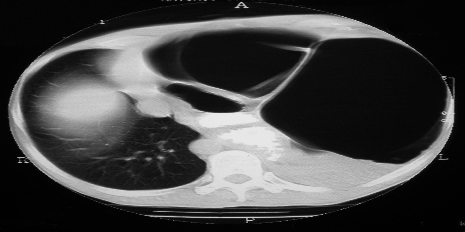 Caso Código 129C de Eventração diafragmática 129C