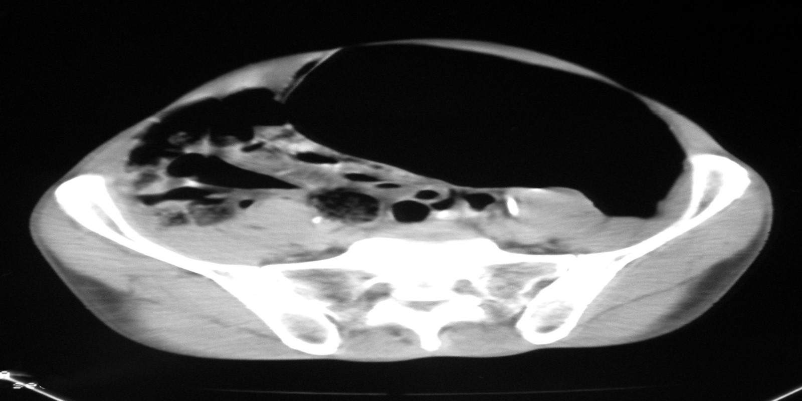 Caso Código 129D de Eventração diafragmática 129D