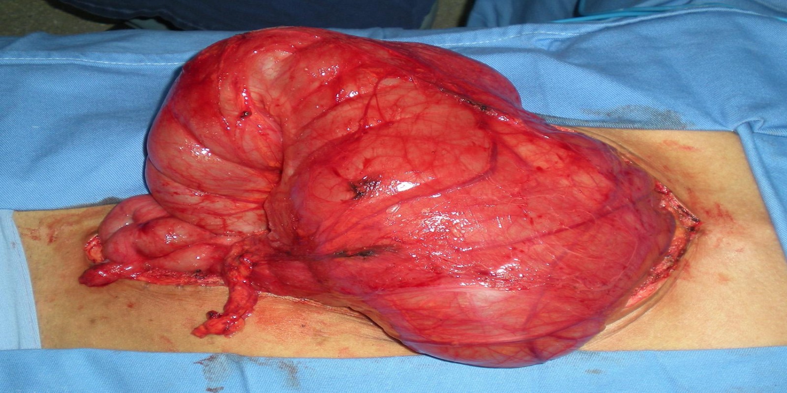 Caso Código 129E de Eventração diafragmática 129E