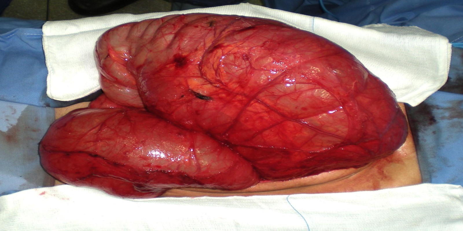 Caso Código 129F de Eventração diafragmática 129F
