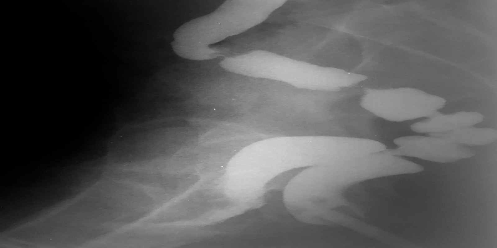 Caso Código 131A de Fístula reto-vaginal 131A