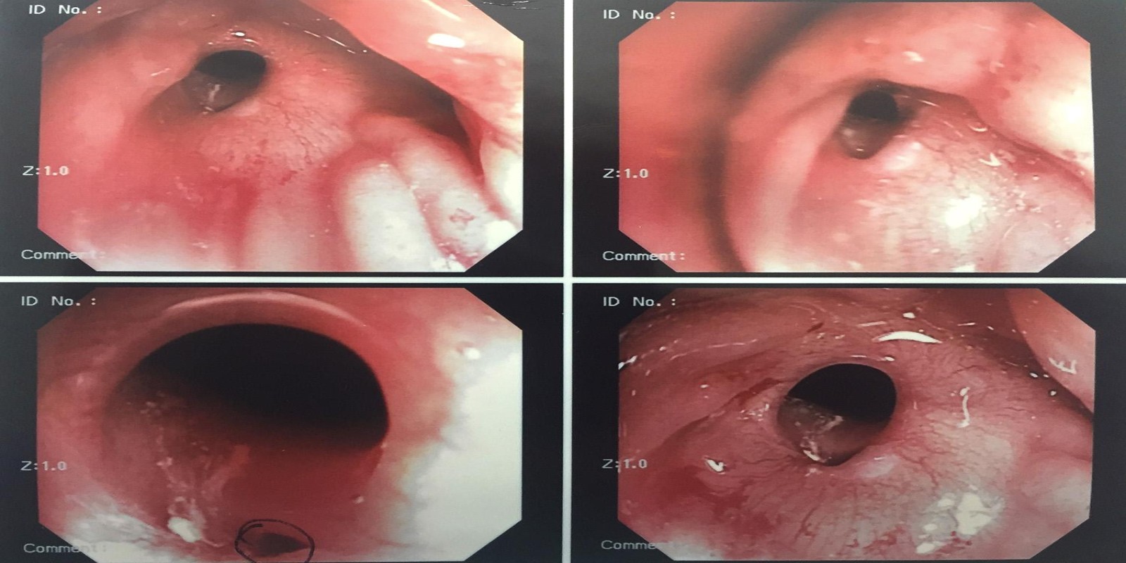 Caso Código 131B de Fístula reto-vaginal 131B