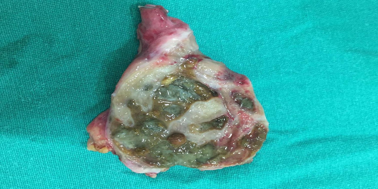 Caso Código 148A de Colecistite Aguda 148A