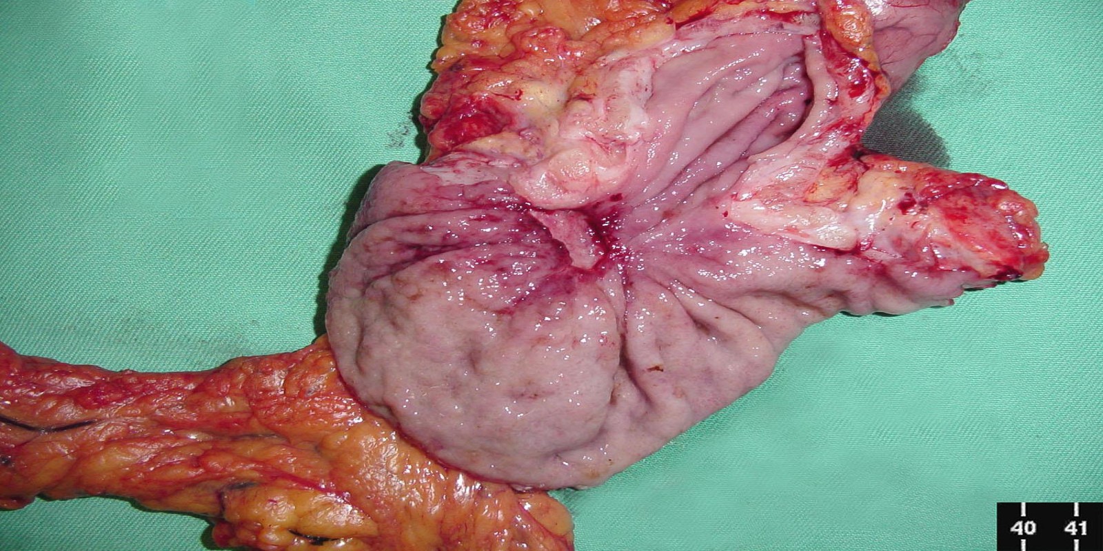 Caso Código 149A de Câncer Gástrico 149A