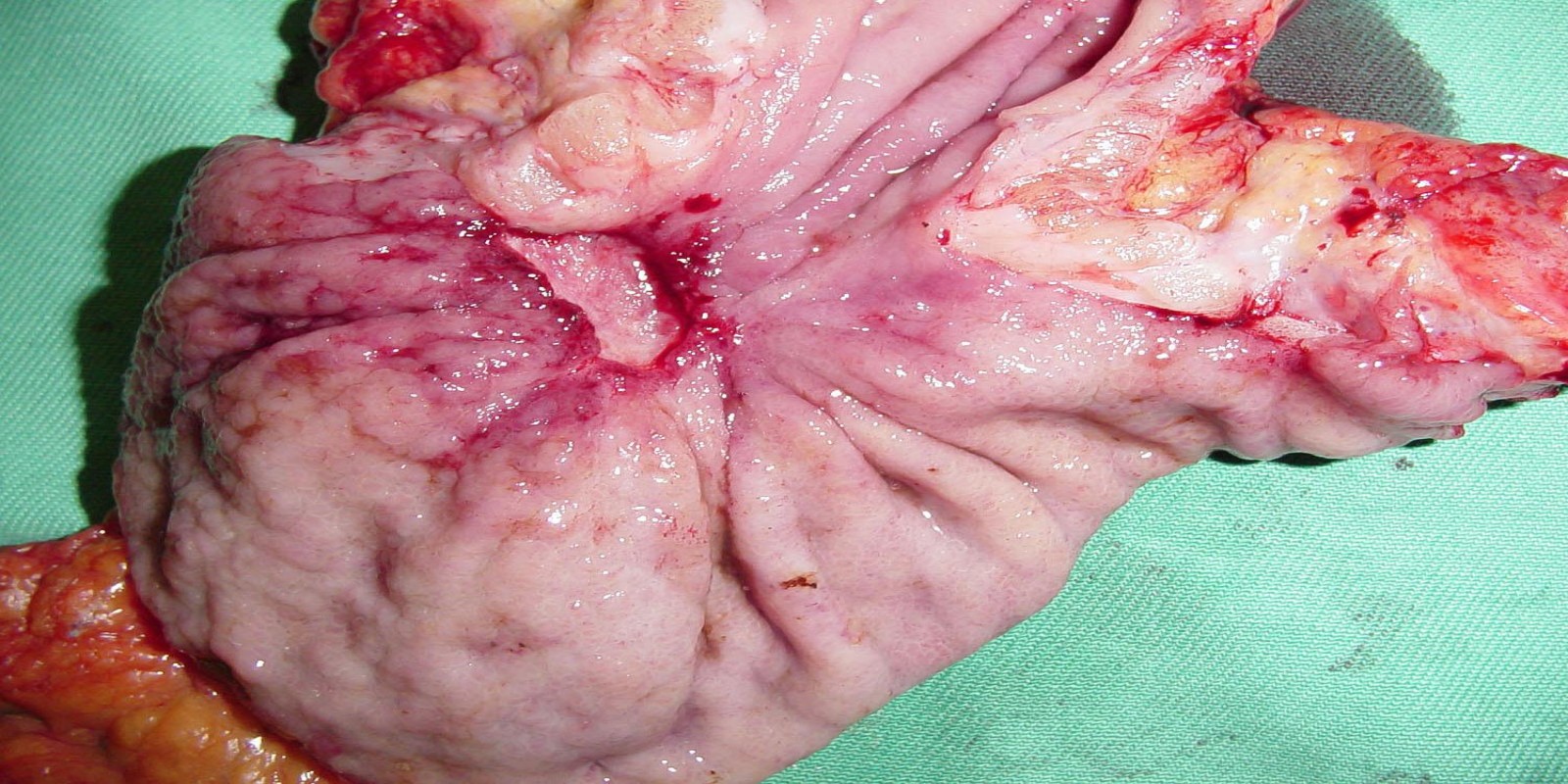 Caso Código 149B de Câncer Gástrico 149B