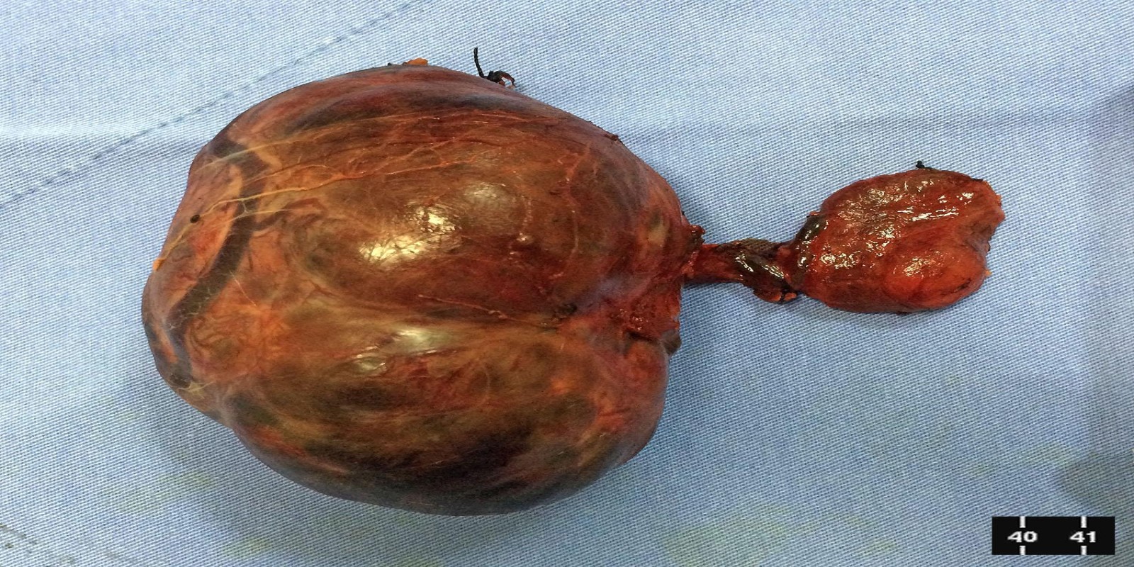 Caso Código 151A de Bócio Multinodular Atóxico 151A