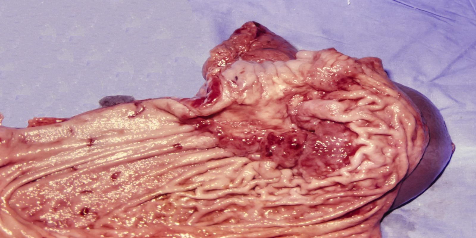 Caso Código 154A de Câncer Gástrico 154A