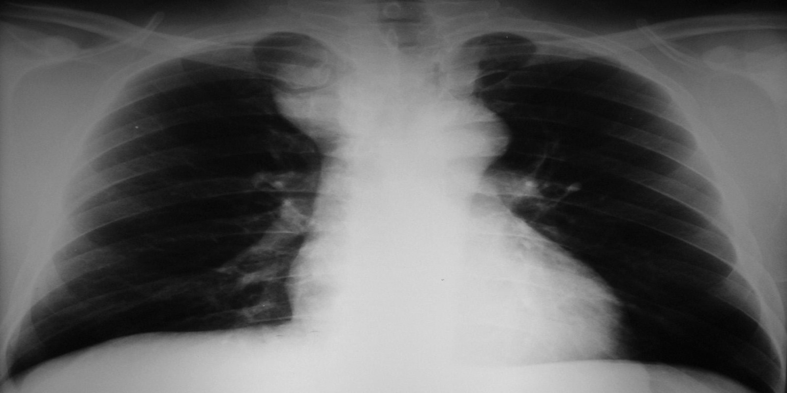 Caso Código 159A de Tireóide ectópica mediastinal 159A