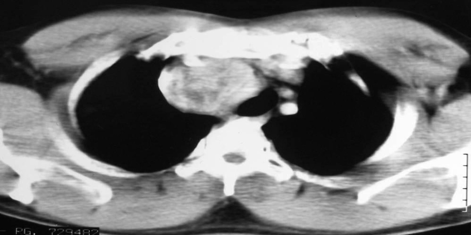 Caso Código 159B de Tireóide ectópica mediastinal 159B