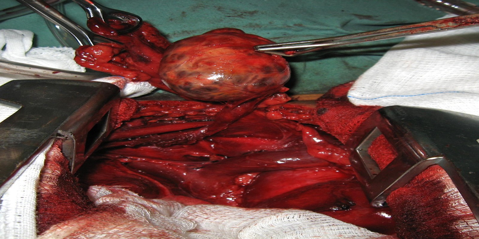 Caso Código 159C de Tireóide ectópica mediastinal 159C