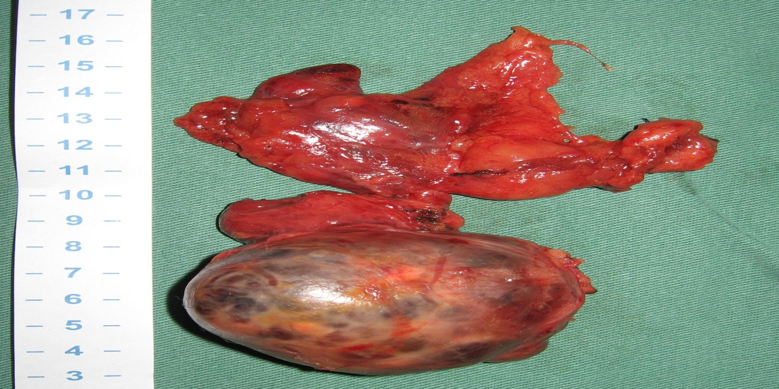 Caso Código 159D de Tireóide ectópica mediastinal 159D