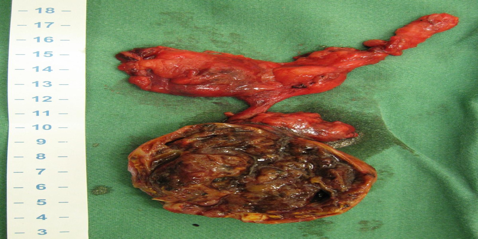 Caso Código 159E de Tireóide ectópica mediastinal 159E